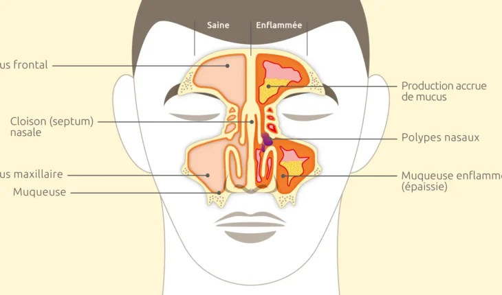 polype nasal