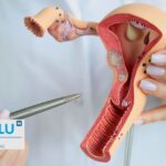 Cancer de l&rsquo;ovaire : Symptômes, diagnostic précoce et traitements innovants