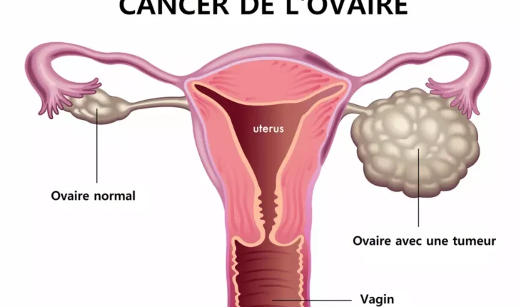 Cancer de l'ovaire