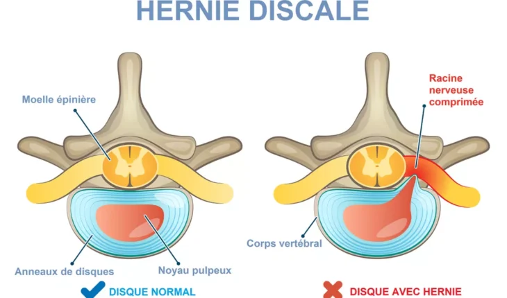 hernie discale