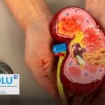 Kystes rénaux : diagnostic, chirurgie, risque de cancer et prévention