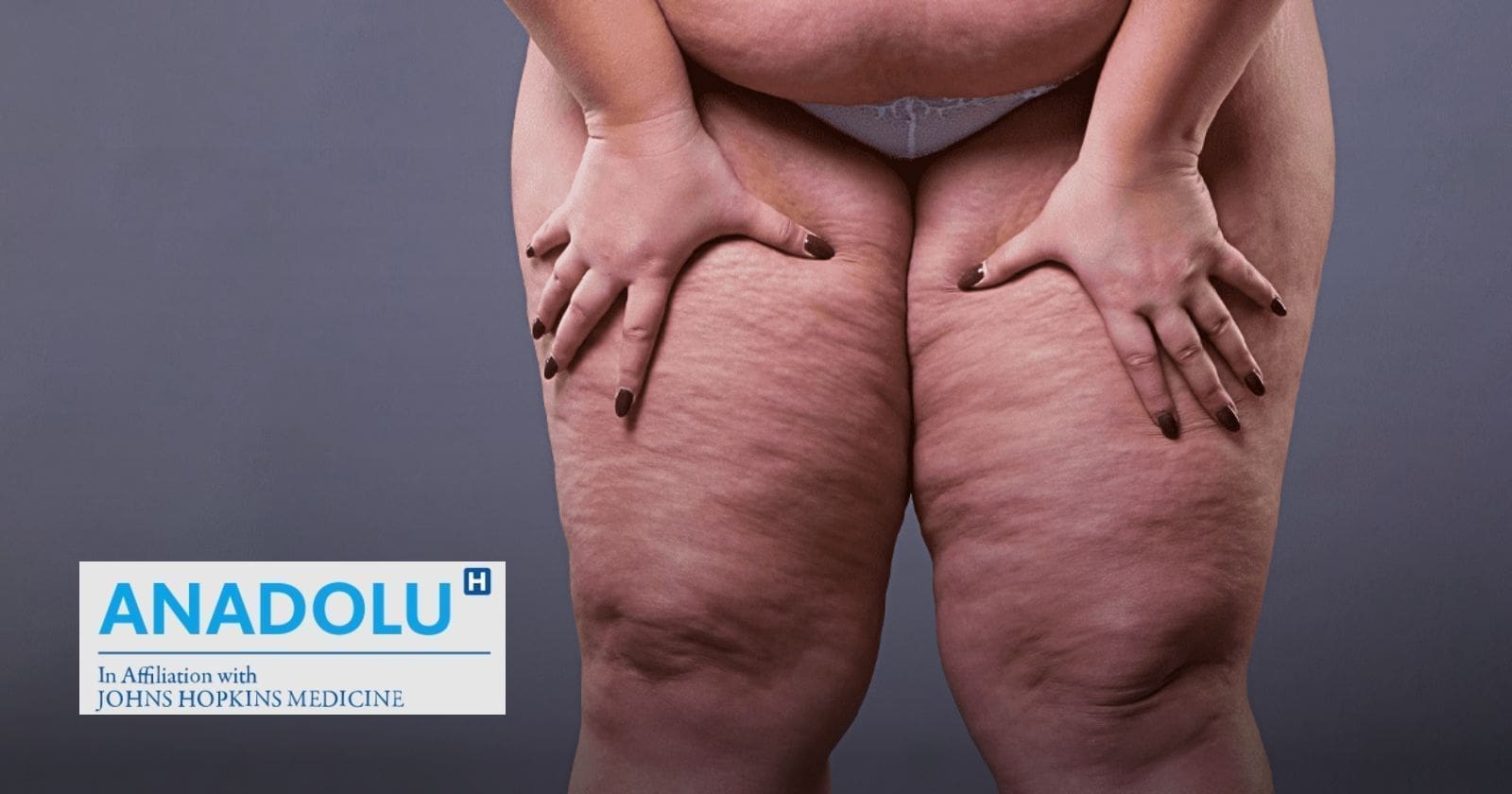 Lipœdème : ne confondez pas ce trouble avec la cellulite ou l’obésité