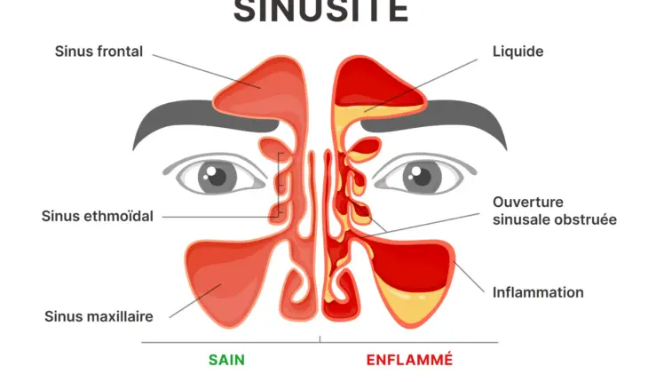 sinusite (schéma)