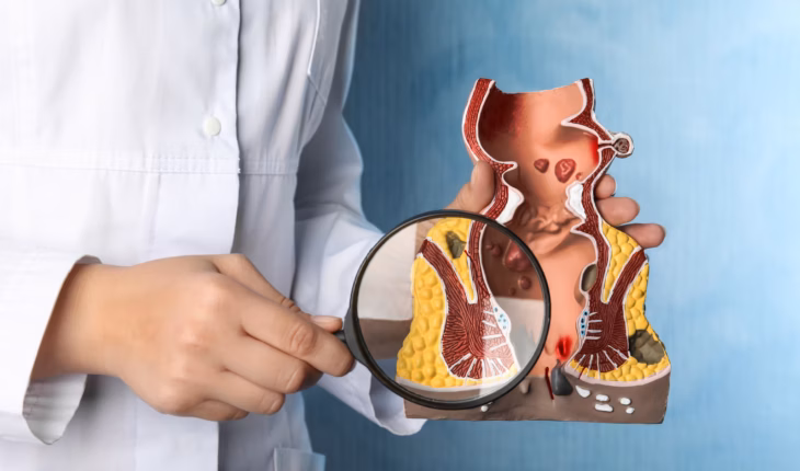 Coupe verticale d'un saignement rectal